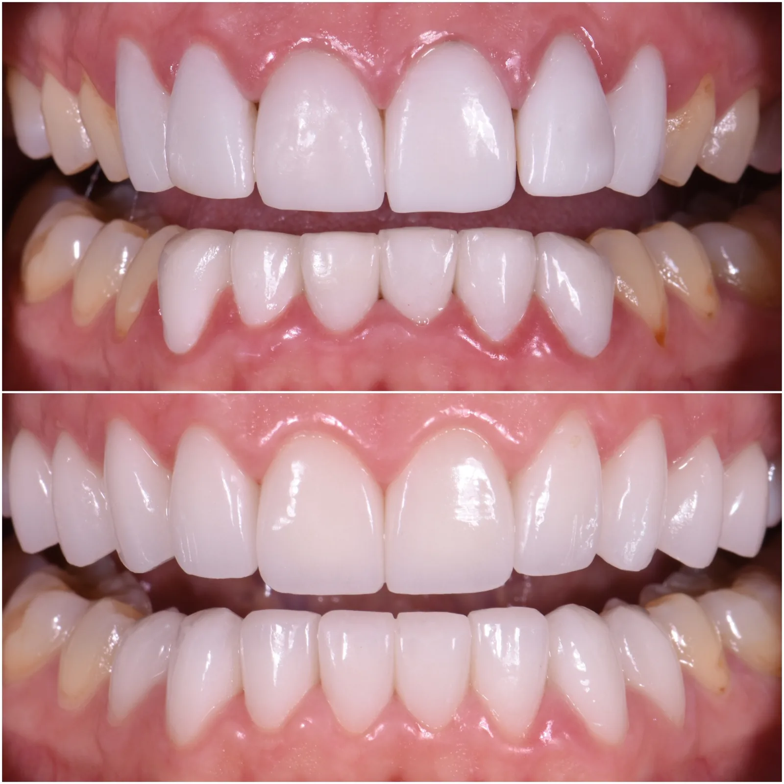 Veneer Redo original before and after case