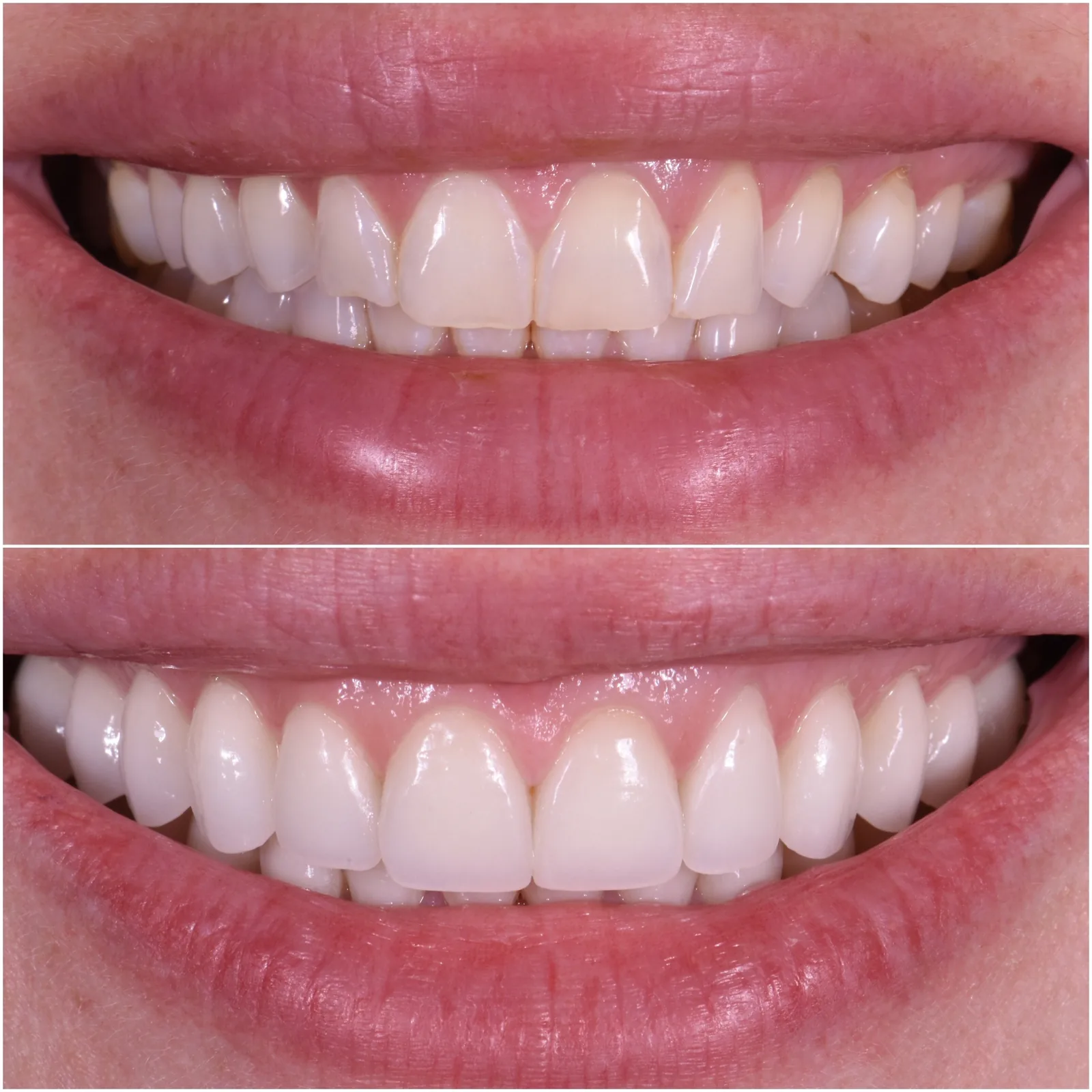 Porcelain Veneers original before and after case