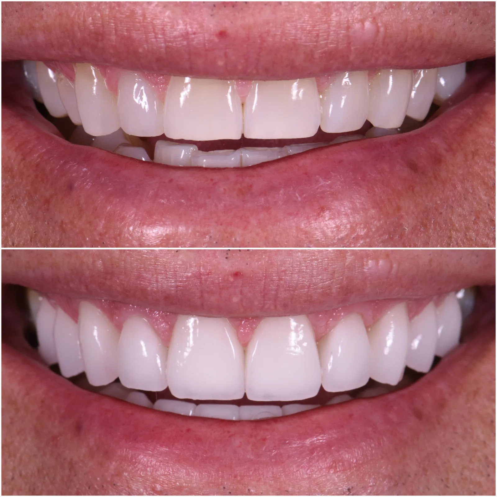 Porcelain Veneers original before and after case