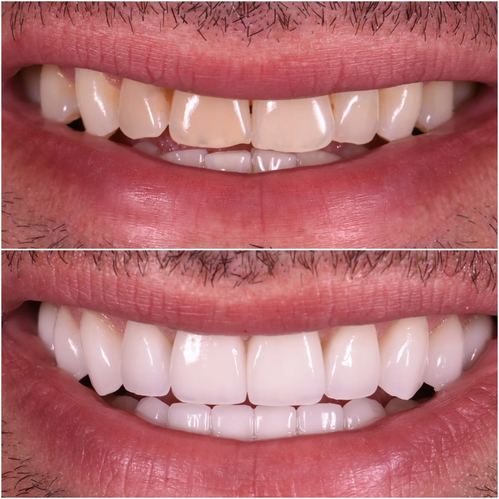 Porcelain Veneers original before and after case