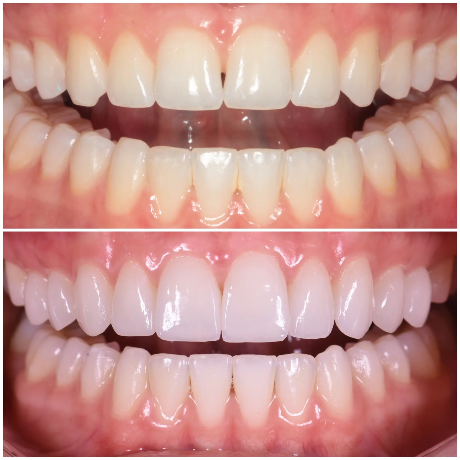 No-Prep Veneers original before and after case