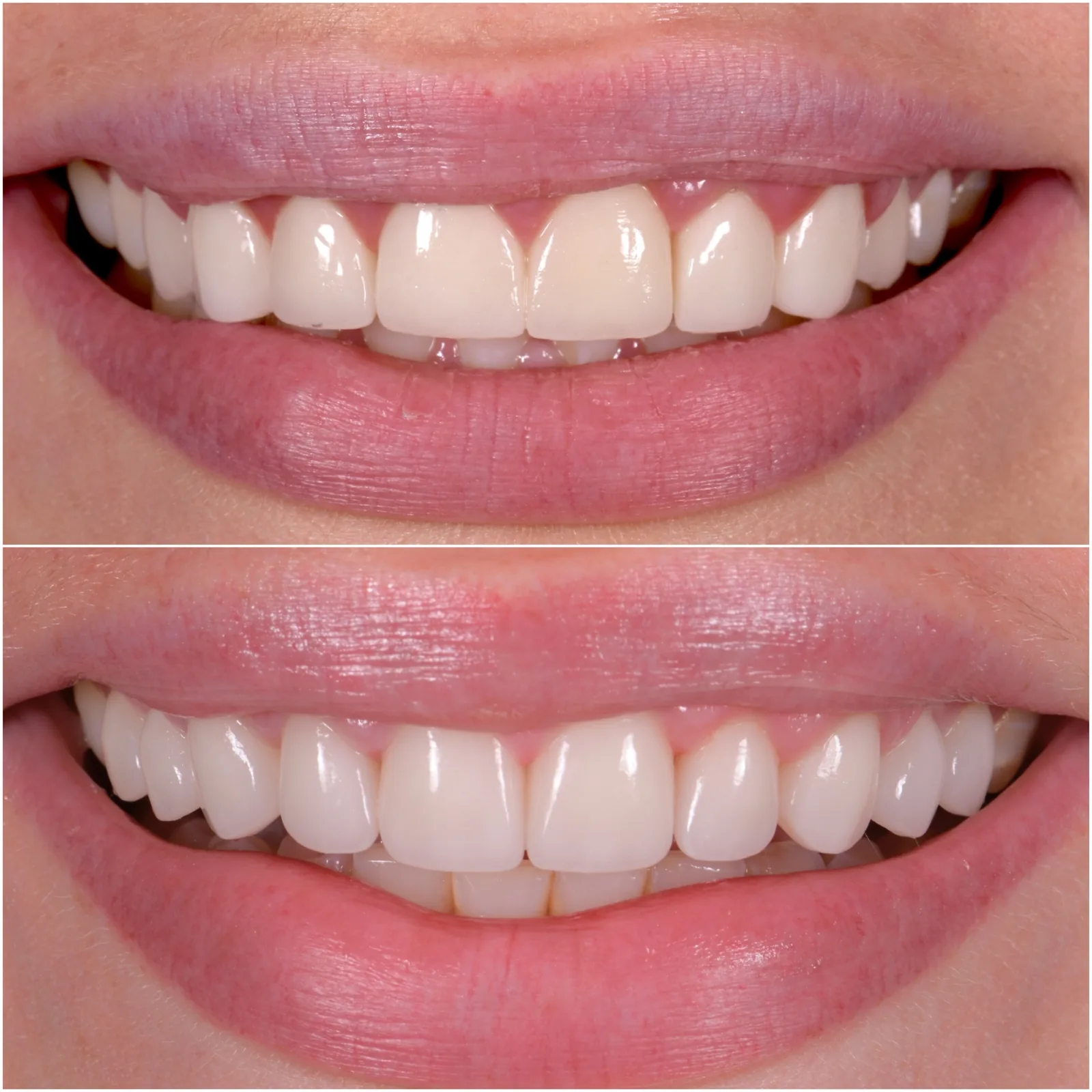 Veneer Redo original before and after case