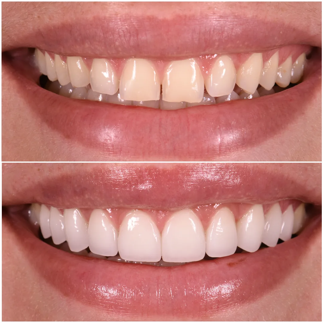 Porcelain Veneers original before and after case
