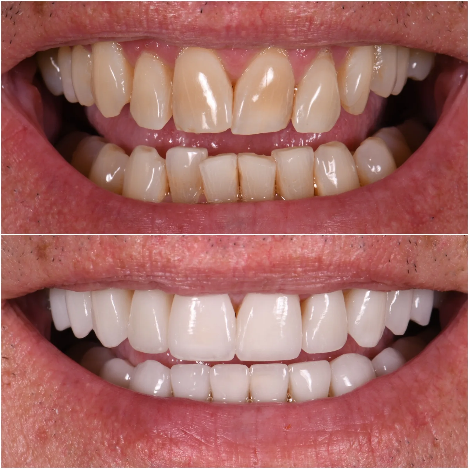 Porcelain Veneers original before and after case