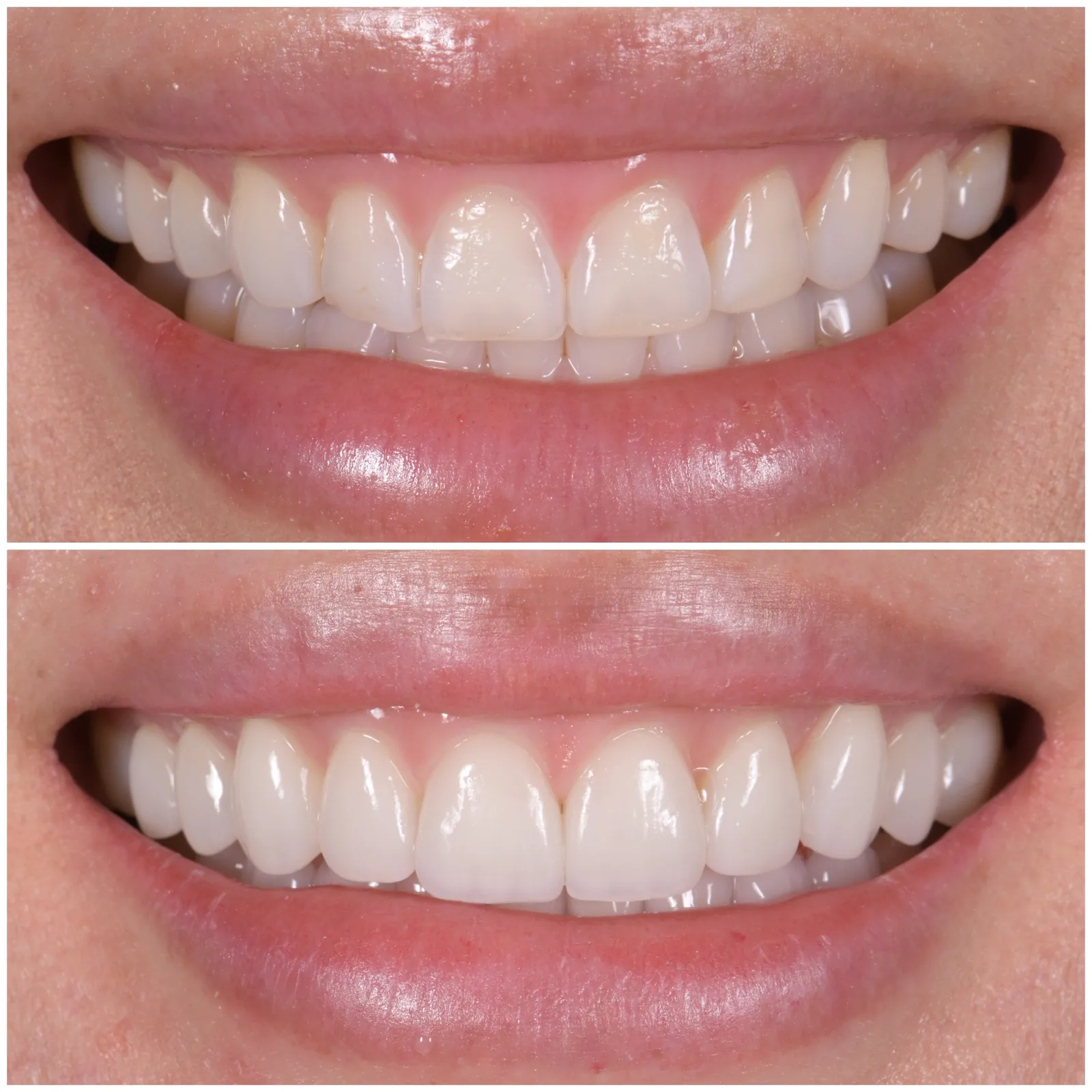 Porcelain Veneers case 1