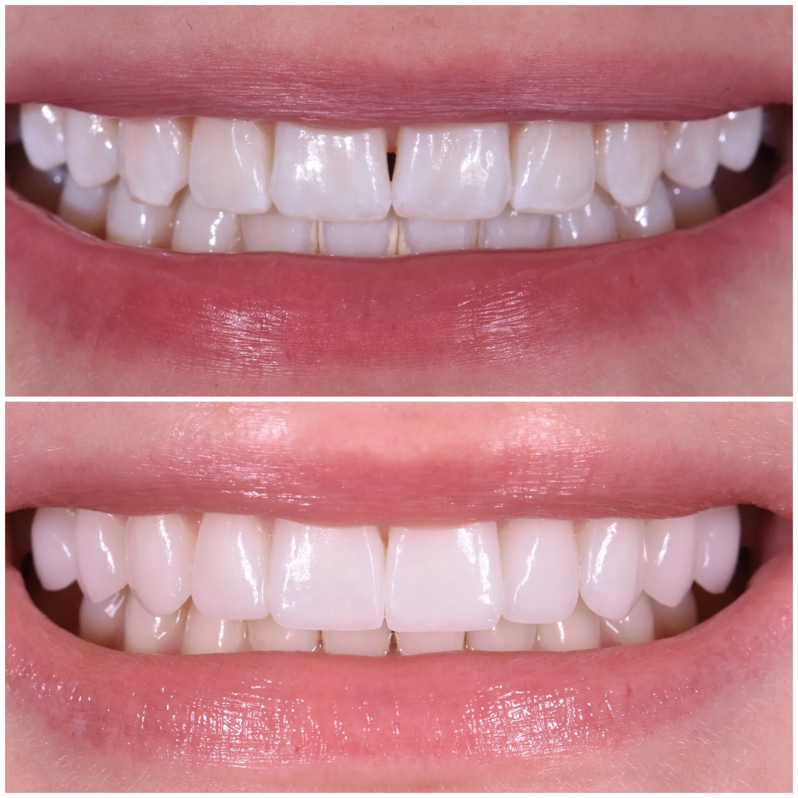 Ava — no-prep porcelain veneers, before and after