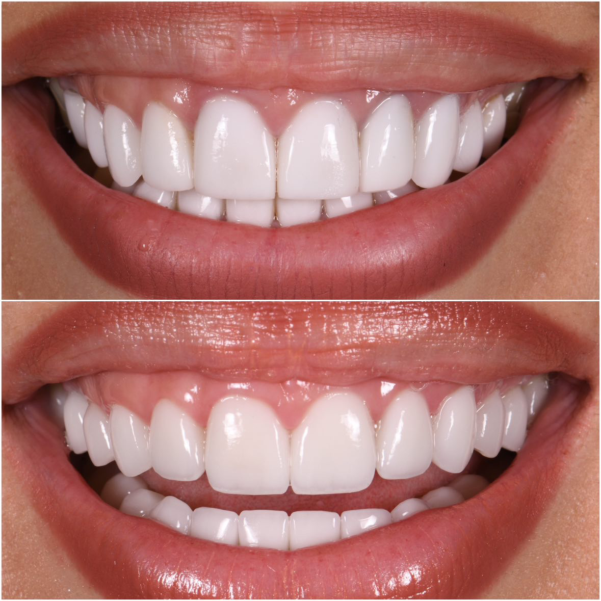 Veneer redo by Dr. Marashi