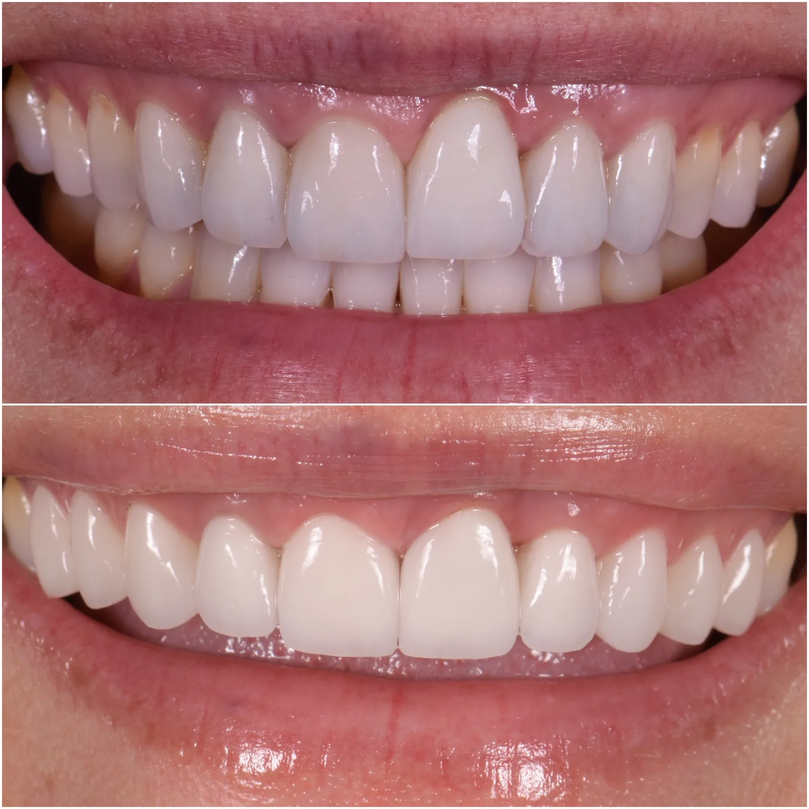 Veneer redo by Dr. Marashi