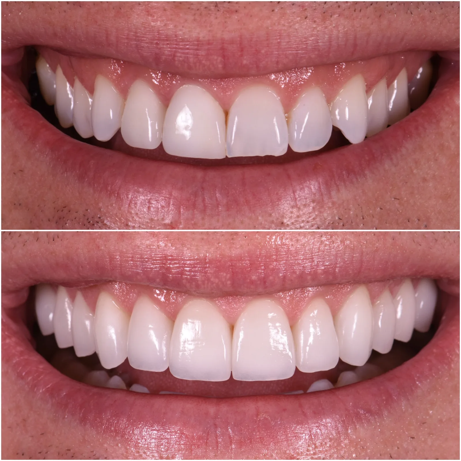 Veneer redo by Dr. Marashi