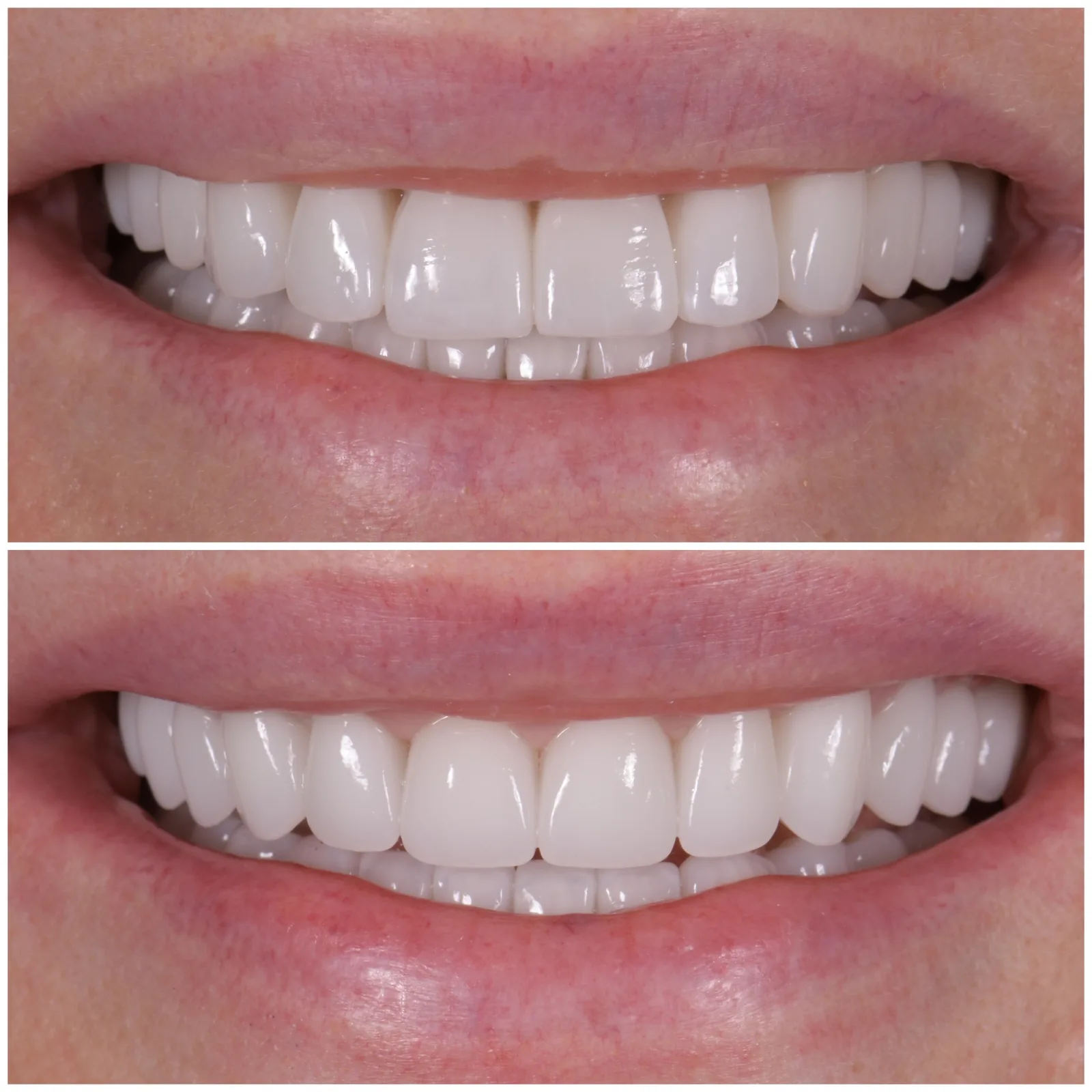 Veneer redo by Dr. Marashi