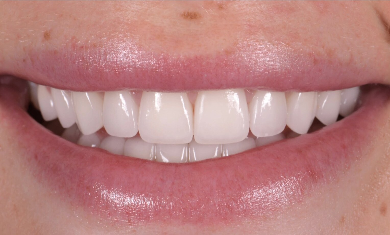 Holly Brooks porcelain veneers after by Dr. Marashi