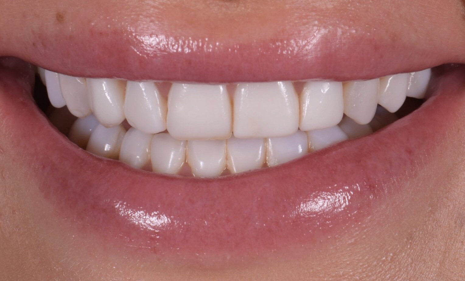 Holly Brooks porcelain veneers before by Dr. Marashi