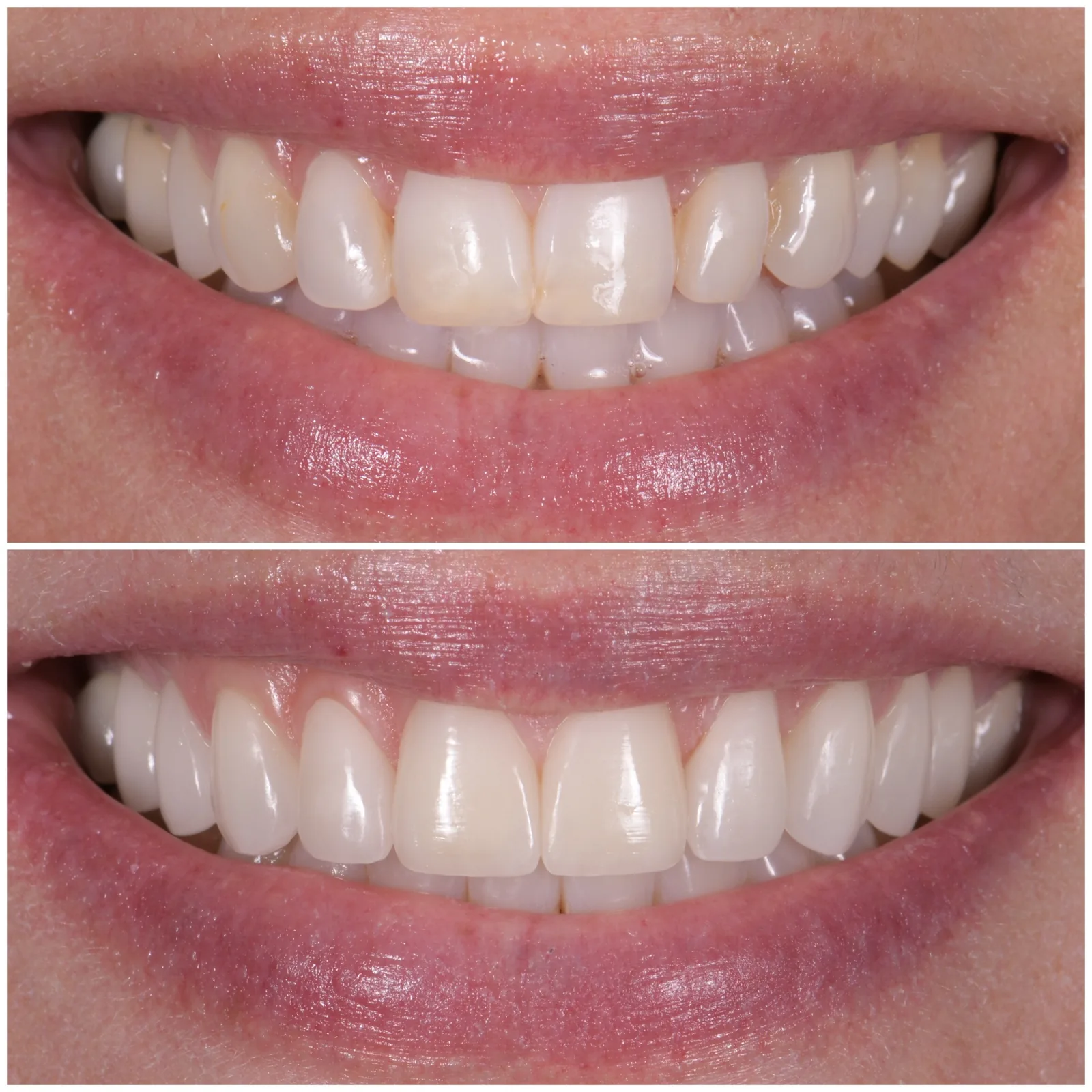 Veneer redo by Dr. Marashi