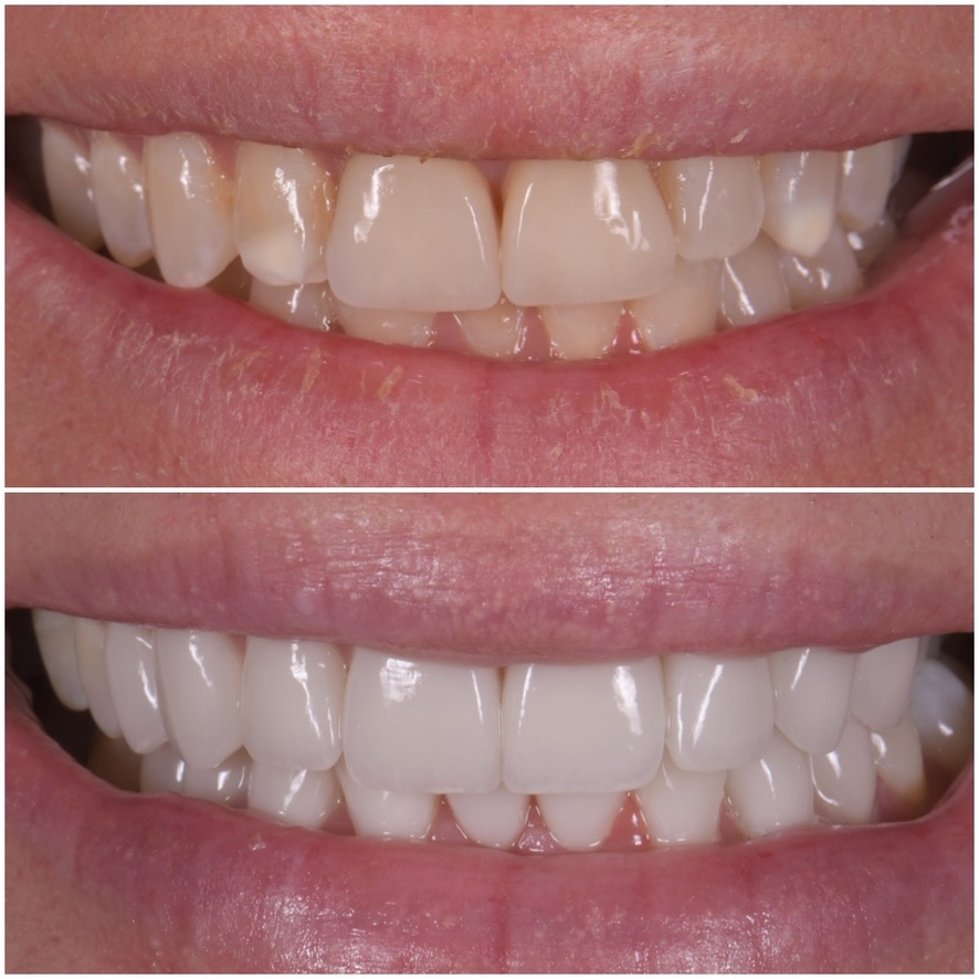 Veneer redo by Dr. Marashi