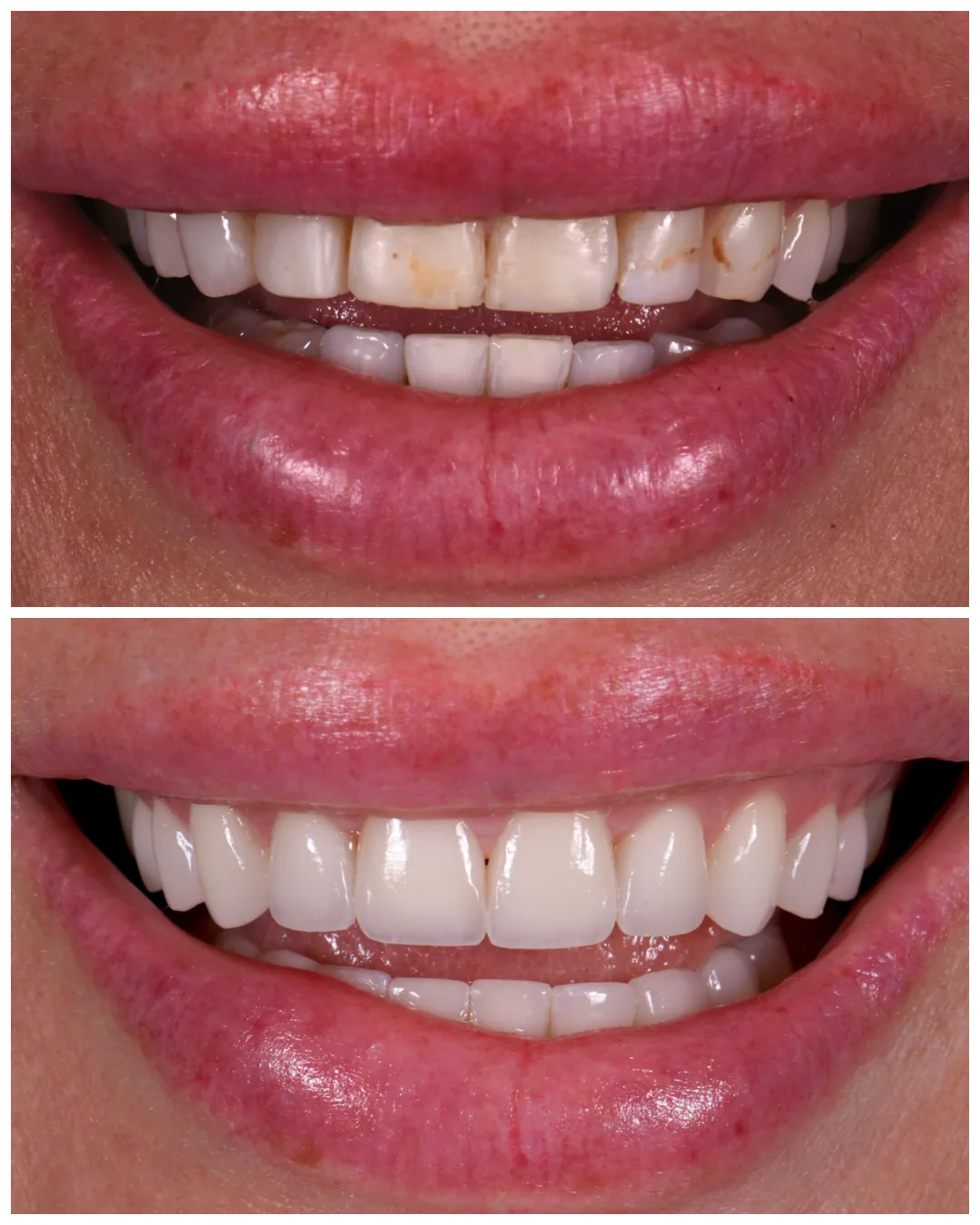 Veneer redo by Dr. Marashi