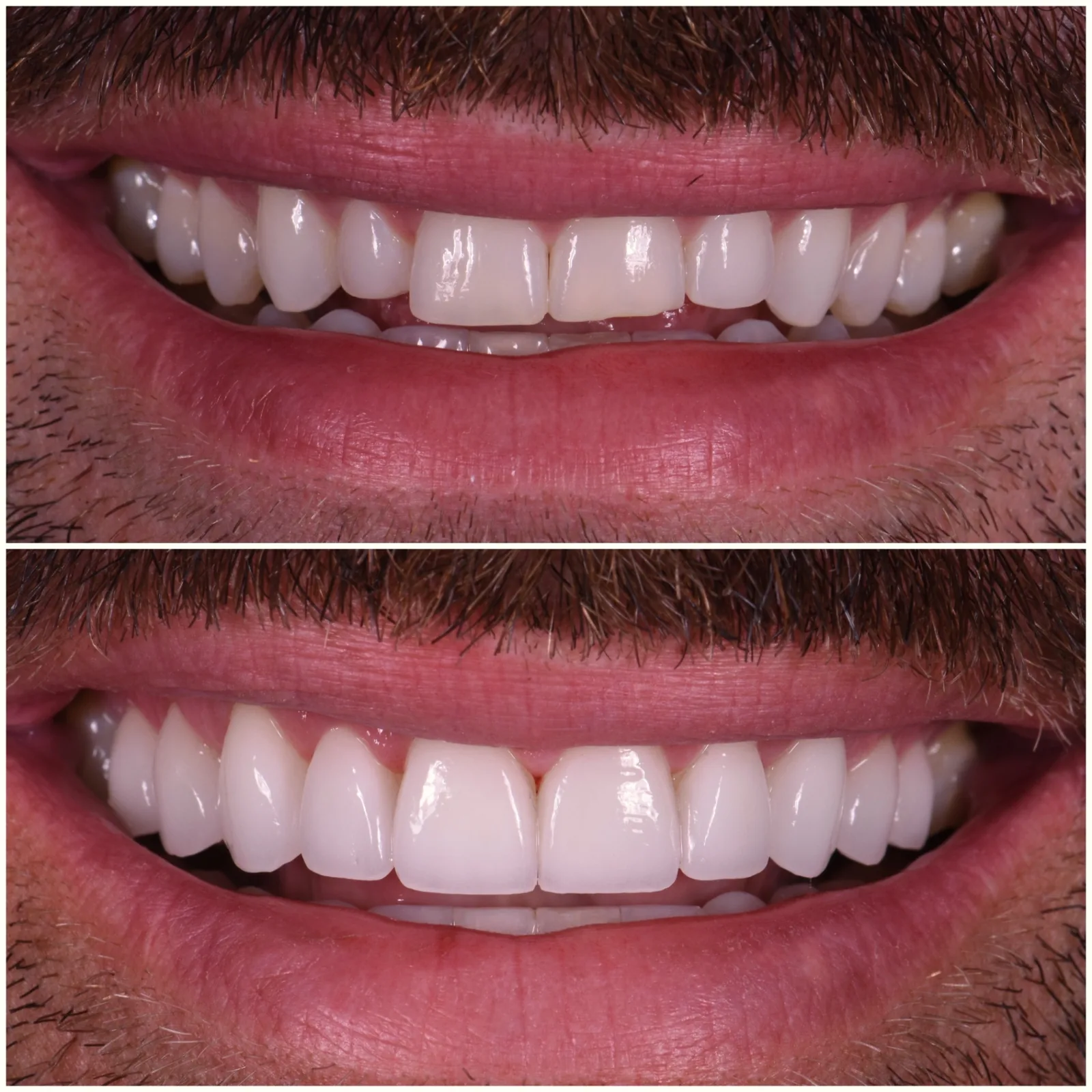 Porcelain Veneers case 3