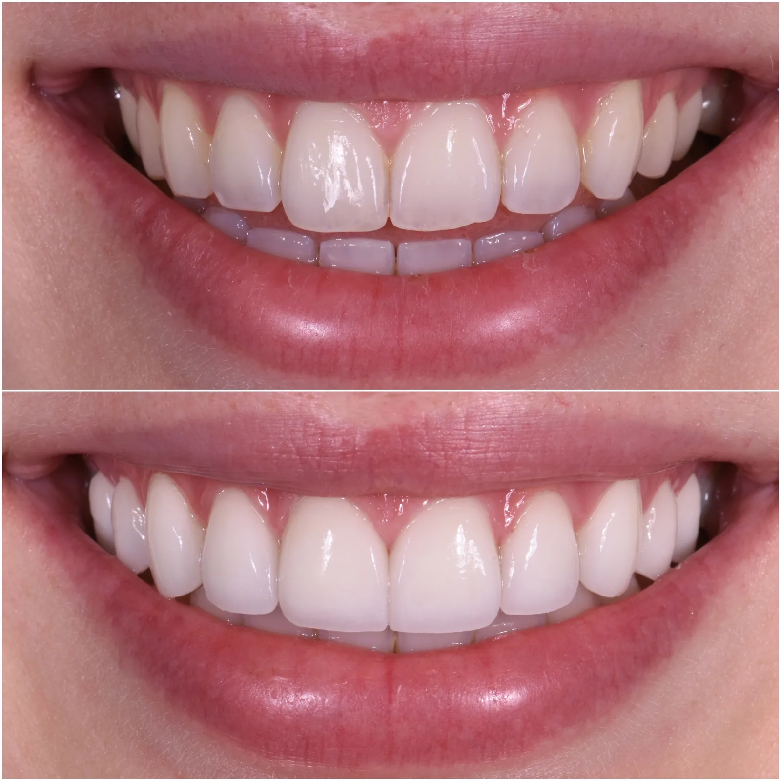 Porcelain Veneers case 2
