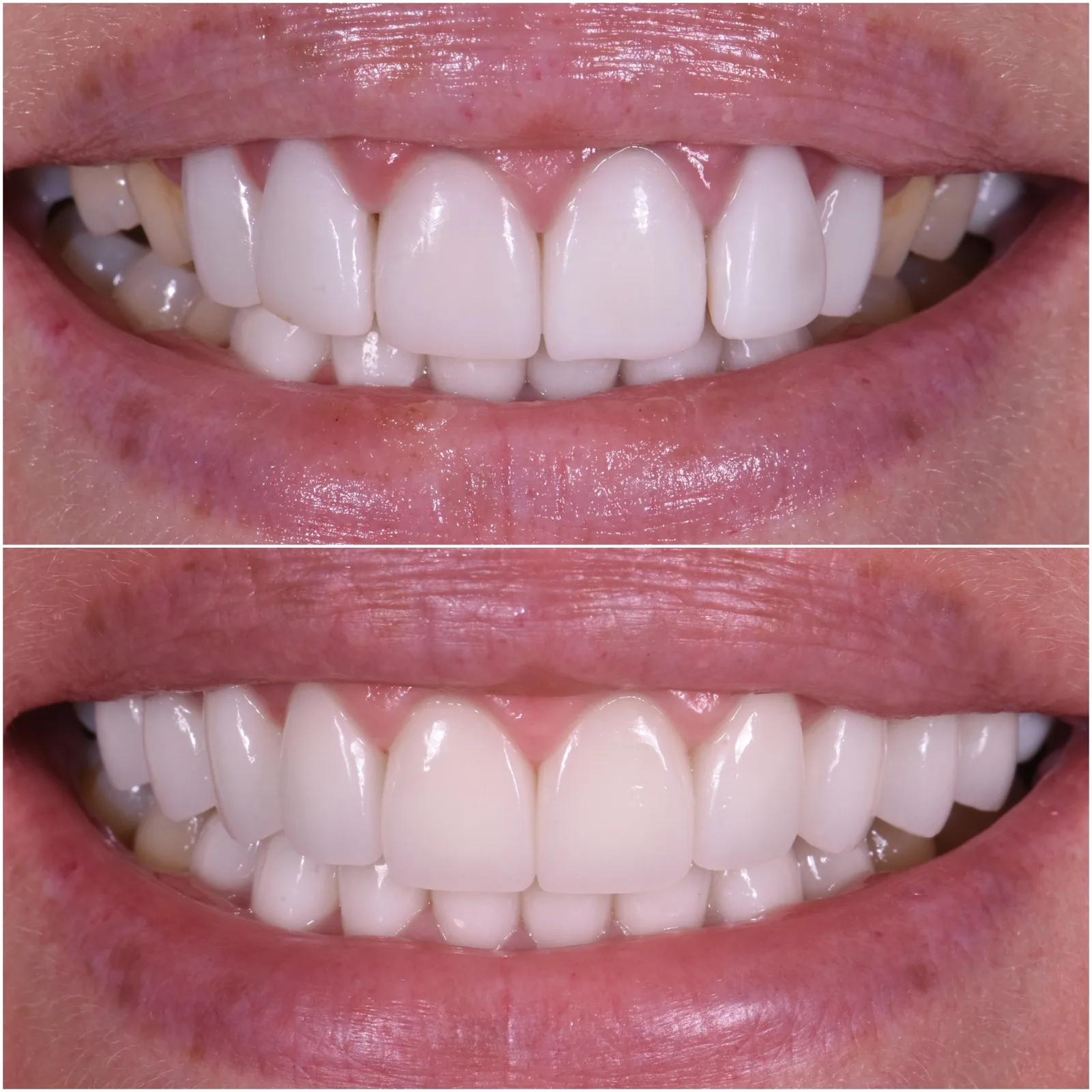 Veneer redo by Dr. Marashi