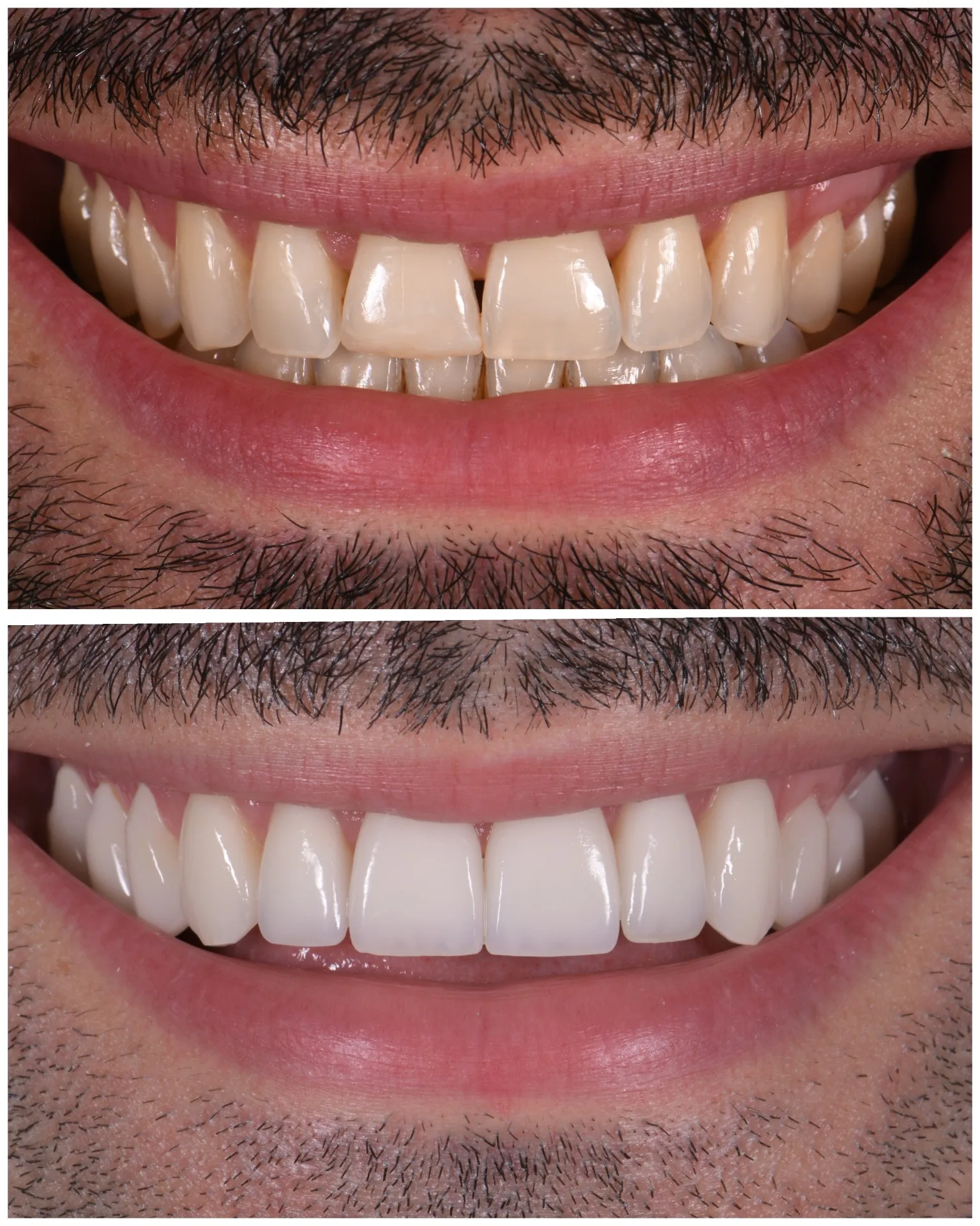 Mourad — no-prep porcelain veneers, before and after