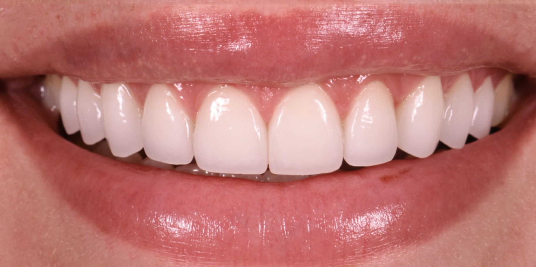 Porcelain veneer transformation - after