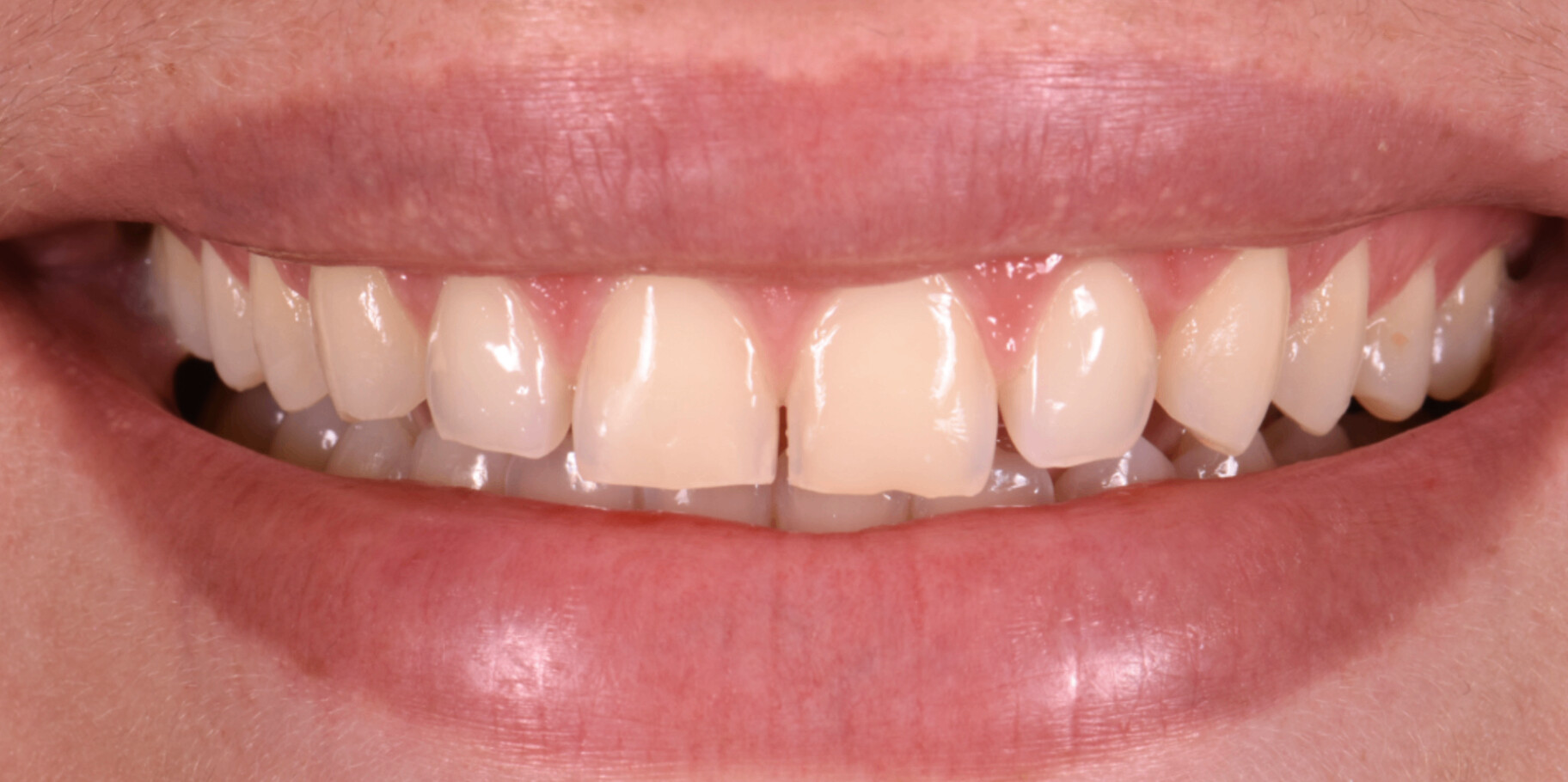 Porcelain veneer transformation - before