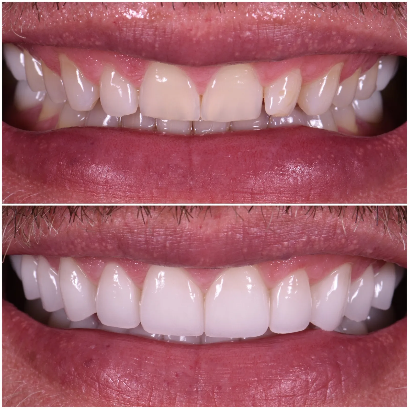 Todd — no-prep porcelain veneers, before and after