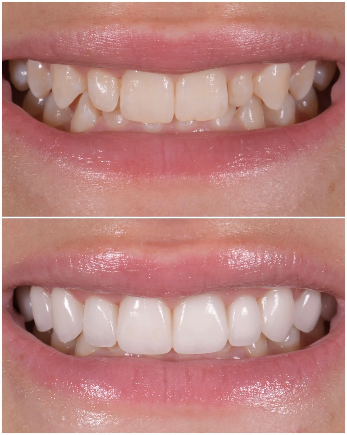 Zoe — no-prep porcelain veneers, before and after